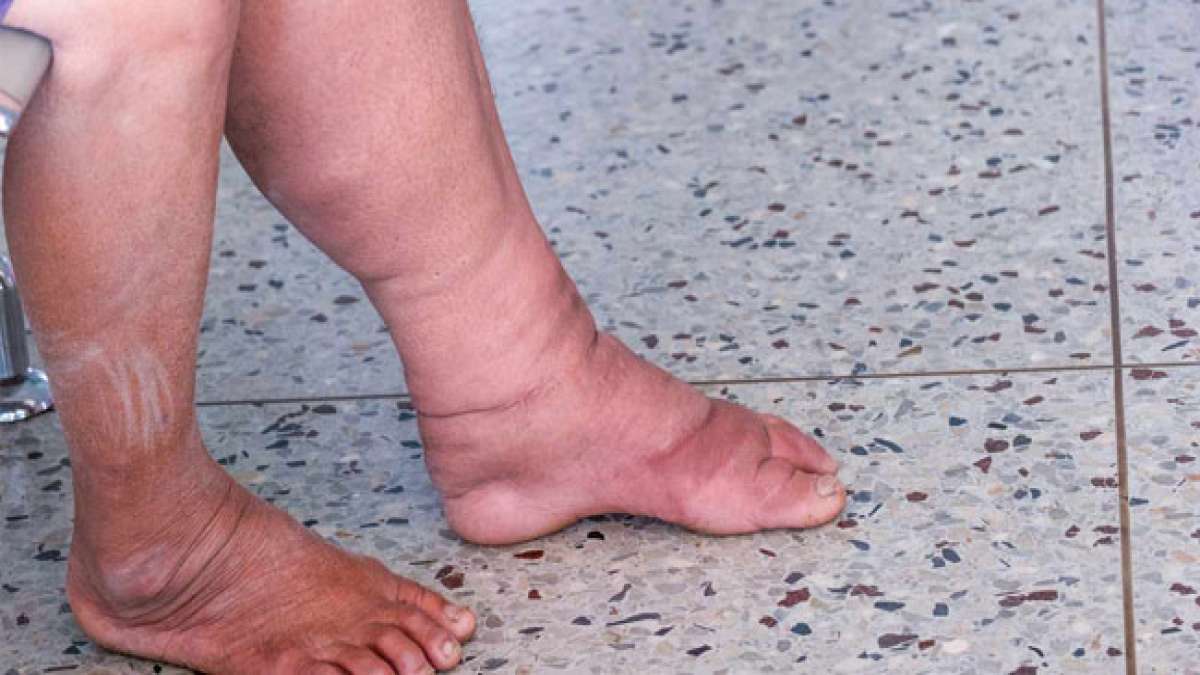 Verleihen Sie dem Welt-Lymphödemtag am 6. März weltweite Bedeutung und unterstützen Sie die Aufklärung über Lymphkrankheiten.