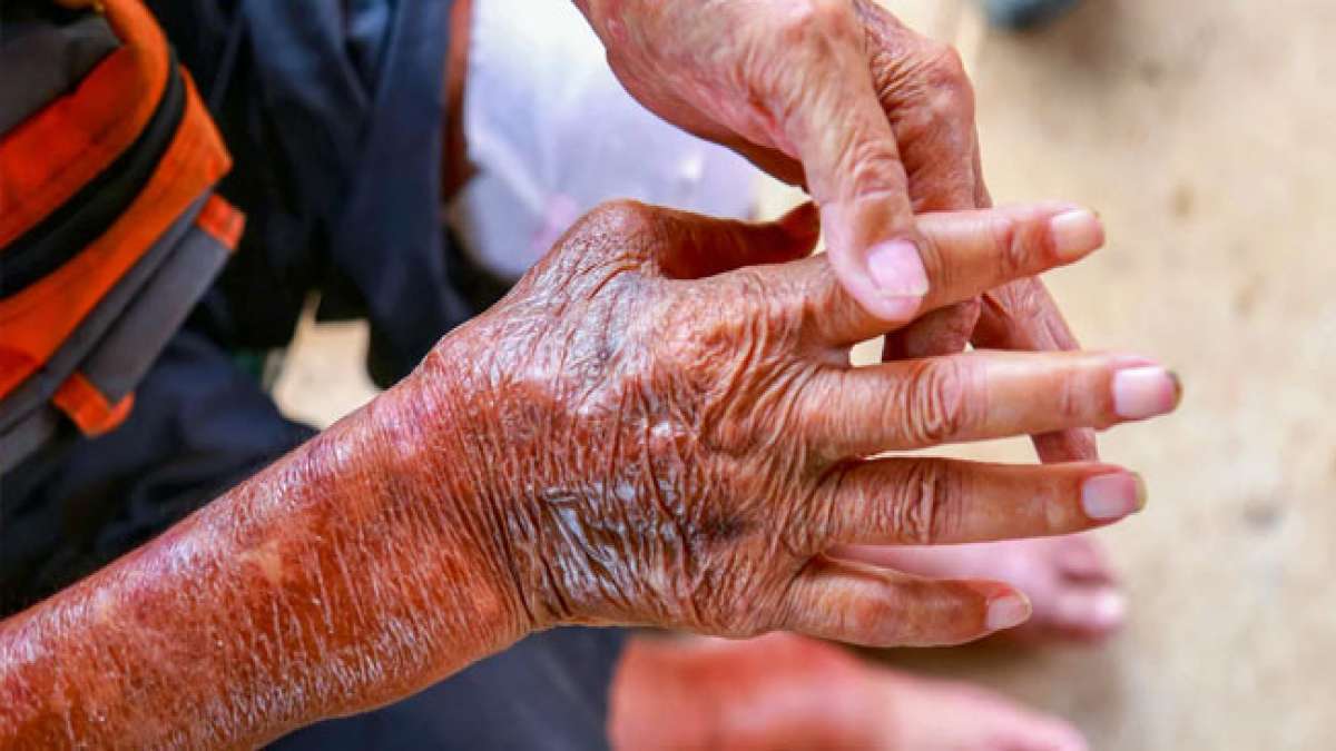 29. Juni – Welt-Sklerodermie-Tag: Ein Tag, um den Mut der Betroffenen zu würdigen und für bessere Behandlungsmöglichkeiten zu kämpfen. 29. Juni – Welt-Sklerodermie-Tag: Ein Tag, um den Mut der Betroffenen zu würdigen und für bessere Behandlungsmöglichkeiten zu kämpfen.