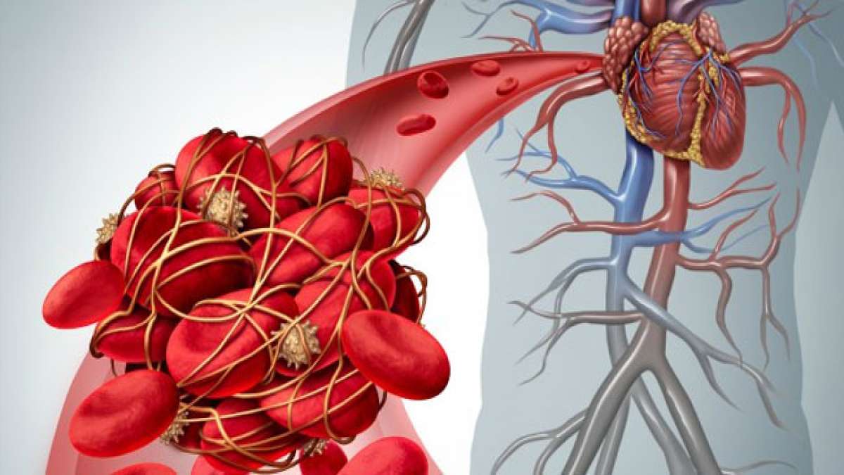 Der Welt-Thrombosetag am 13. Oktober widmet sich der Aufklärung über Thrombose, einer oft unterschätzten Gefahr.