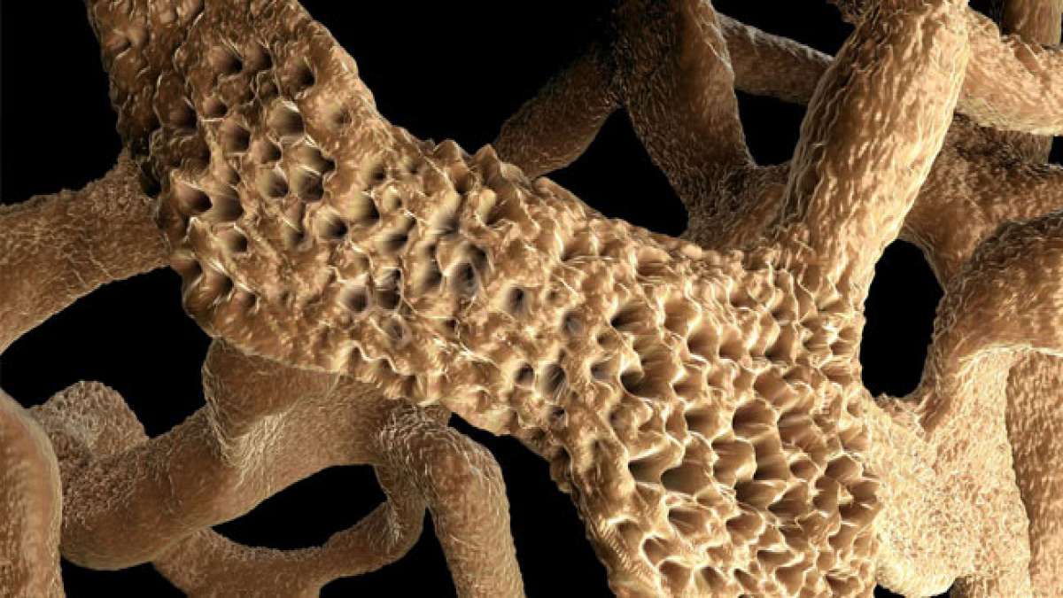 Am 20. Oktober wird der Welt-Osteoporose-Tag begangen. Ziel ist es, Menschen dabei zu helfen, Knochenbrüche zu vermeiden.