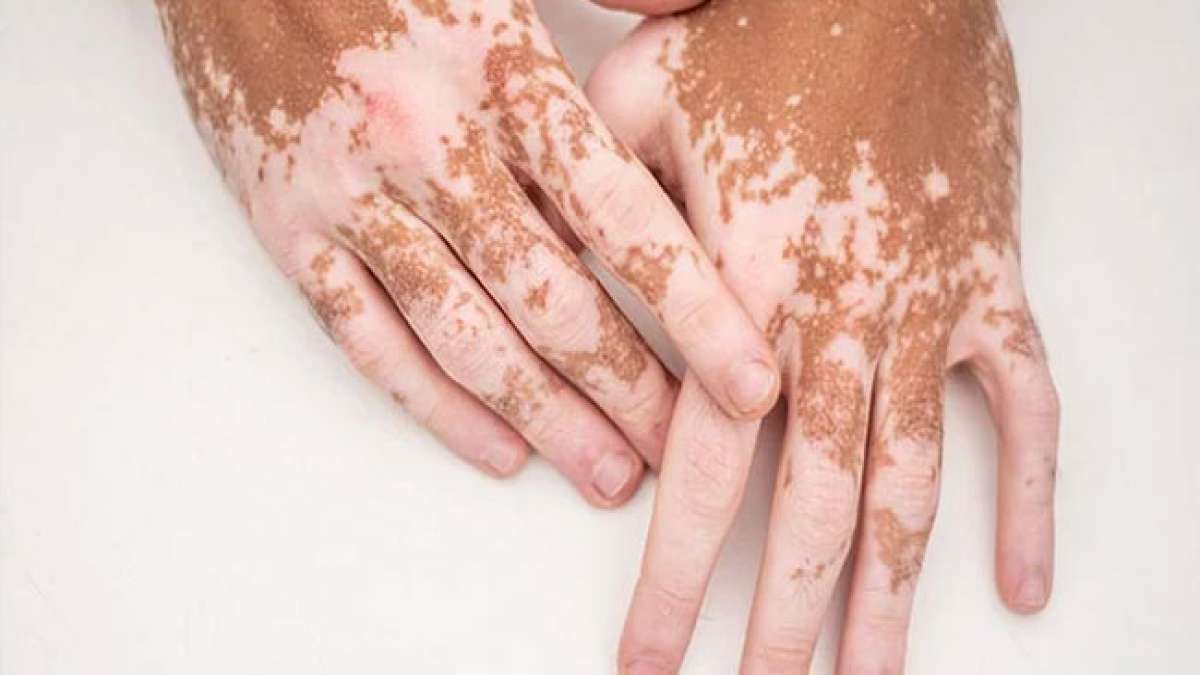 Gemeinsam erhellen wir das Bewusstsein für Vitiligo und setzen uns gegen Stigmatisierung und Mythen ein.
