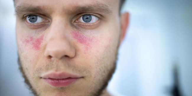 10. Mai - Welt-Lupus-Tag