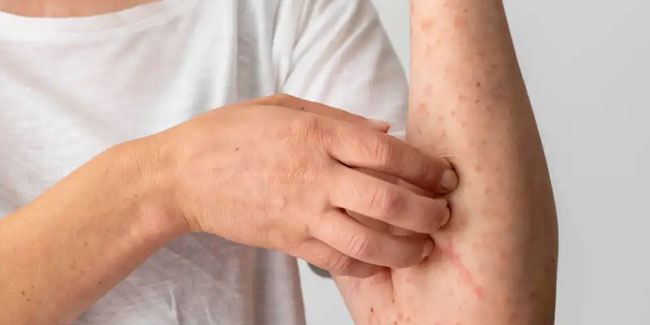 6. Juni - Welttag der Verneuilschen Krankheit