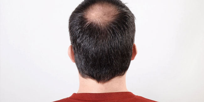 7. Oktober: Welttag der Glatze