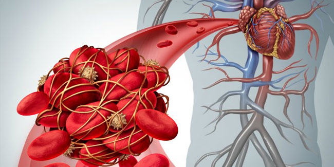 13. Oktober: Welt-Thrombosetag