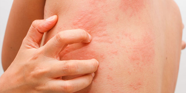 20. Oktober: Internationaler Tag der Mastozytose und Mastzellkrankheiten