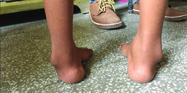 3. Juni: Weltklumpfußtag