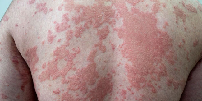 29. Oktober: Welt-Psoriasis-Tag