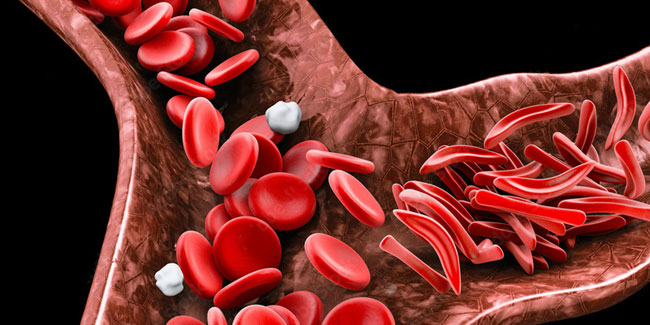19. Juni: Welt-Sichelzell-Tag
