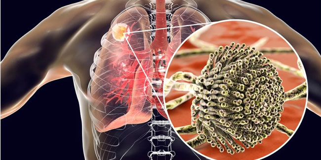 1. Februar: Welt-Aspergillose-Tag